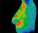 Breast thermography image