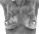 Breast thermography image